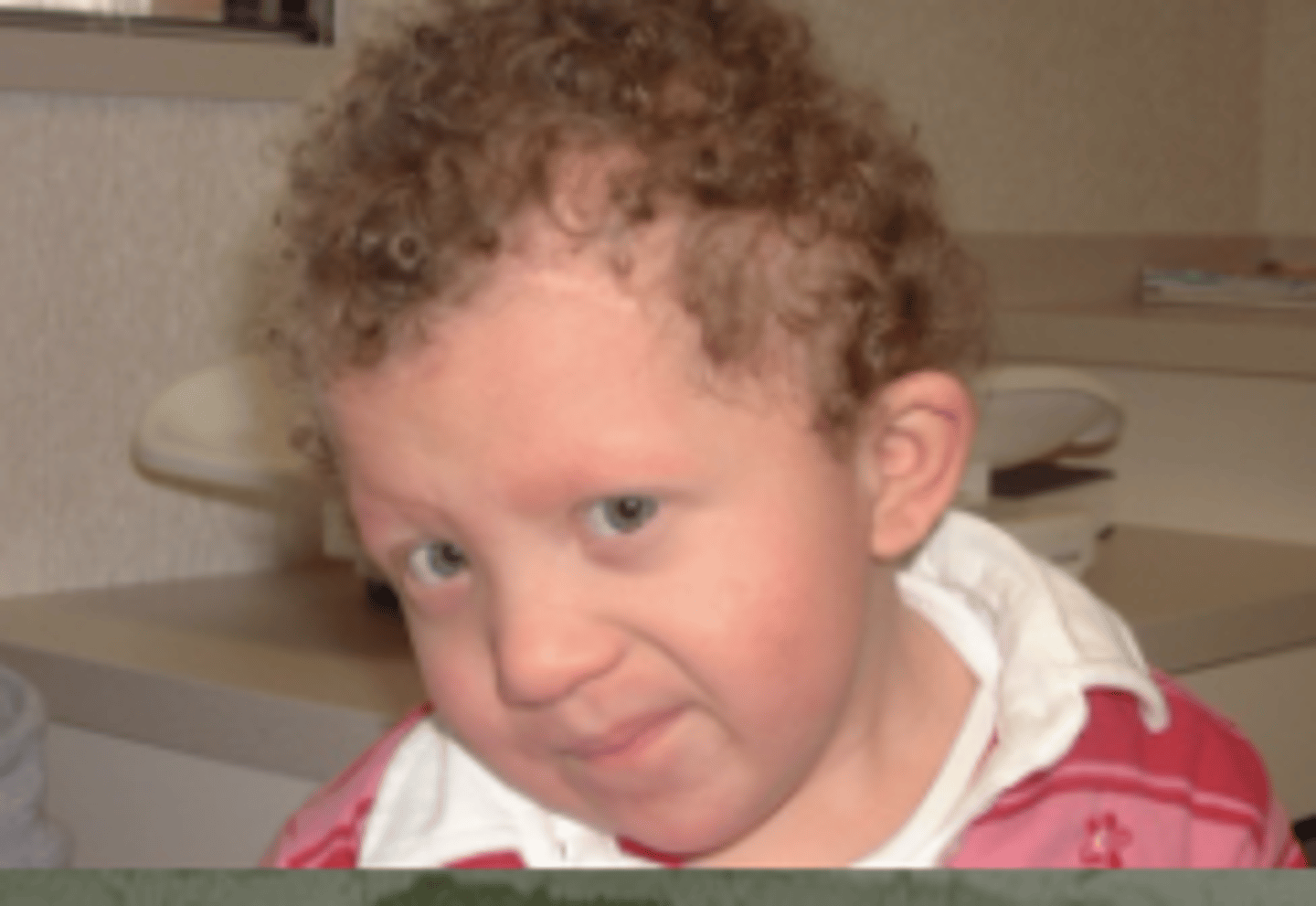 <p>Cardiofaciocutaneous syndrome</p>