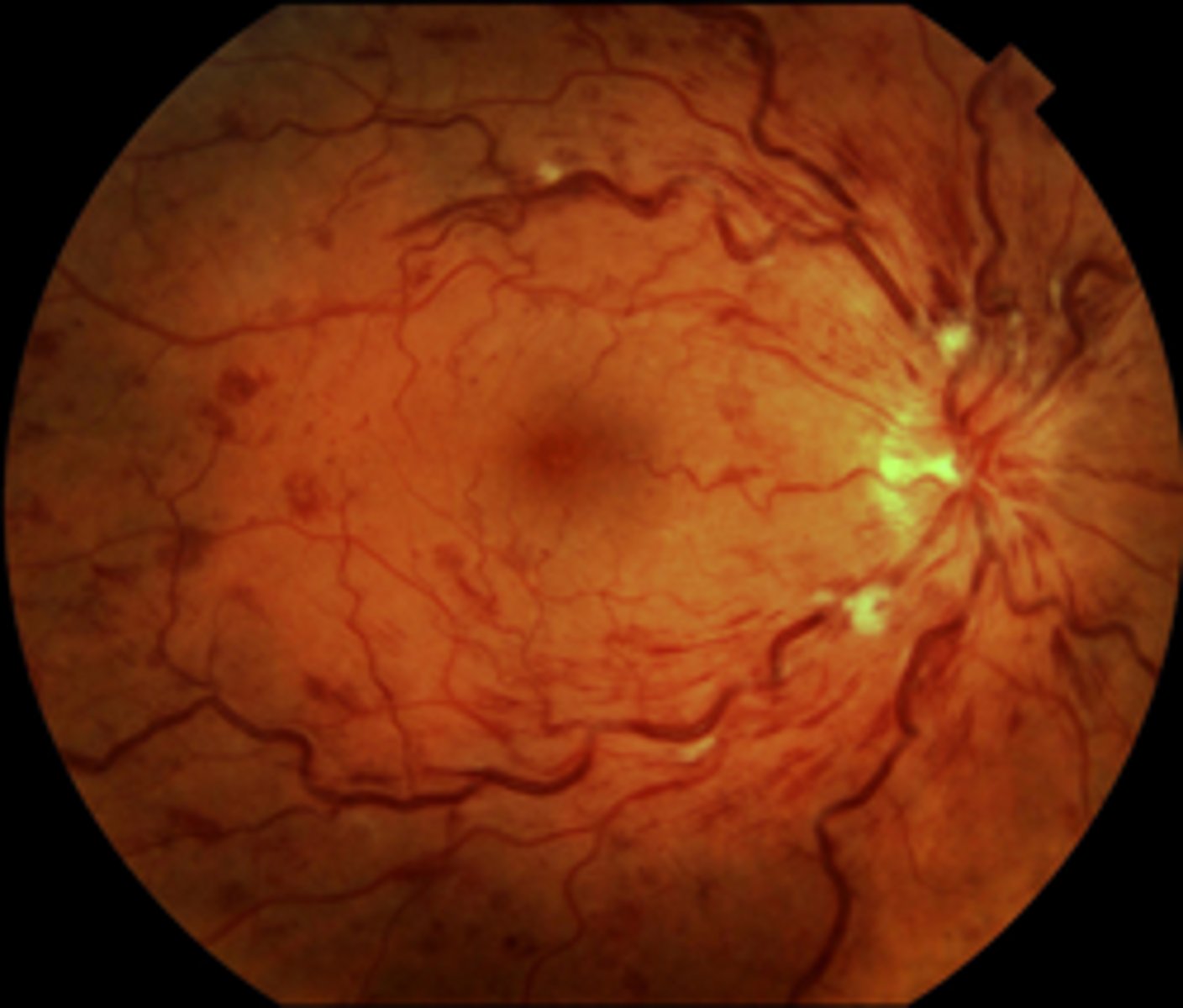 <p><u>Etio:</u> <strong>sudden monocular loss of vision</strong></p><p><u>Risk Factors</u>: DM, HLD, OC, smoking, glaucoma</p><p><u>S&amp;S</u>: no pain, no redness, <strong><mark data-color="#e4ff00" style="background-color: #e4ff00; color: inherit">"blood and thunder" retina</mark>, </strong>neovascularization</p><p><u>Tx</u>: emergent consult to ophtho → prevent retinal detachment, PCP tx underlying cause</p>