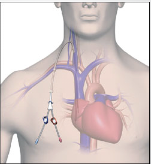 <p><strong><u>Placed as temporary (non-cuffed - lasts days) or long-term (cuffed, tunnel direct catheter - lasts weeks-months)</u></strong><br>→typically older patients, last resort option</p><p><em>Location:</em><br>- internal jugular vein is preferred site (over subclavian vein)</p><p><em>Limitations</em><br>- HIGH risk thrombosis<br>- HIGH risk for infection (serious heart)<br>-recirculation<br>-decreased flow rate on hemodialysis<br>-no showers (sponge bath only)</p><p><em>Advantages:</em><br>- hemodialysis can be initiated immediately</p>