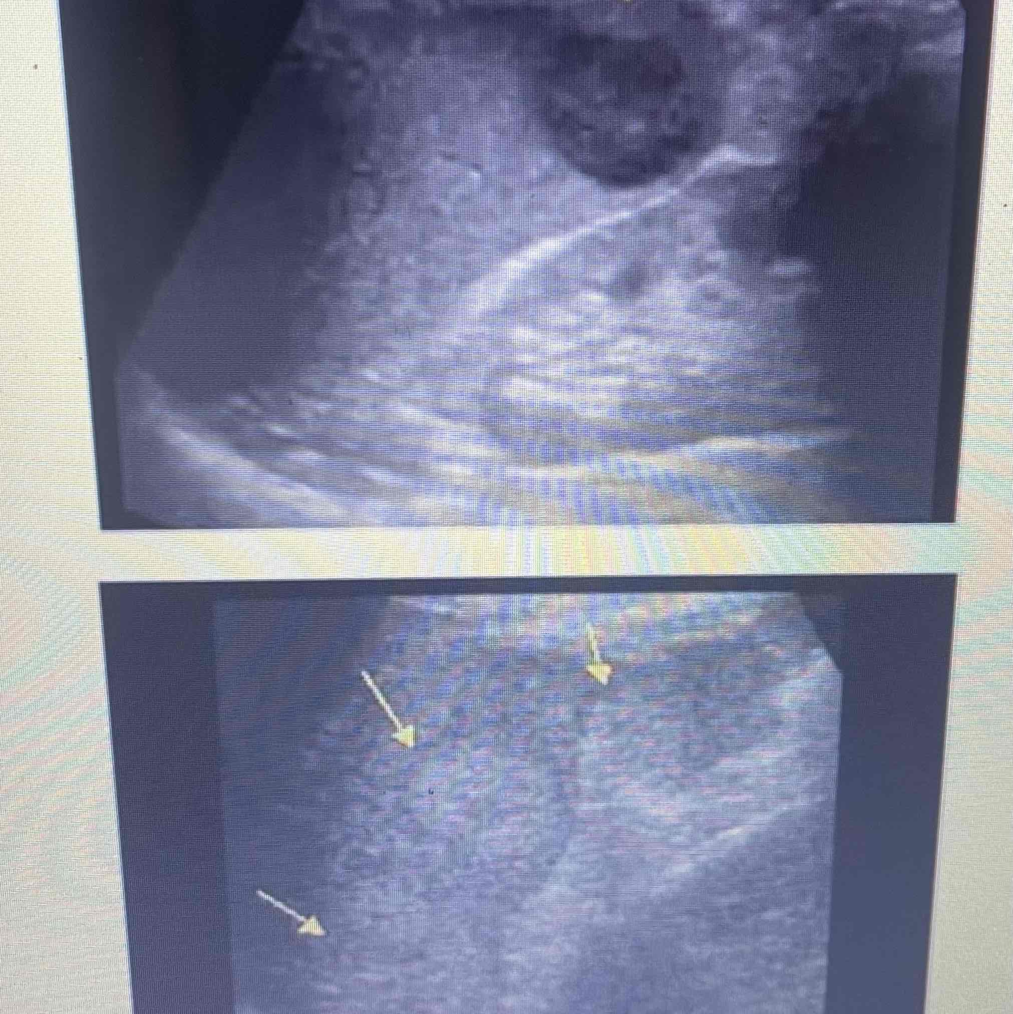 <ul><li><p>Hematogenous spread from primary site</p></li><li><p>Spleen is 10th MC site of mets</p></li><li><p>Clinically: history of ca</p></li><li><p>Sonographic: Multiple or solitary, nodularity, diffuse lesions, target or halo lesions</p></li></ul>