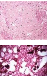 <p>Classical Bovine Spongiform Encephalopathy BSE</p>