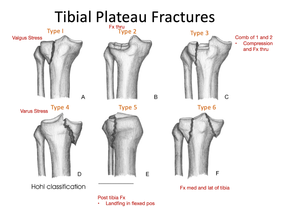 <p>Knee: Tibial Plateau Fx</p><ul><li><p>Describe the 6 types of Tibial Plateau Fx utilizing the Hohl Classification System: </p></li></ul><p></p>