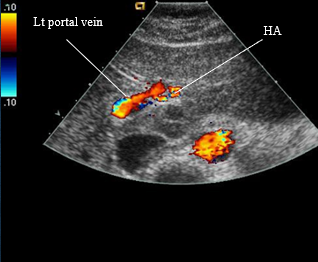 <p>hepatic artery is superior to the main PV</p>