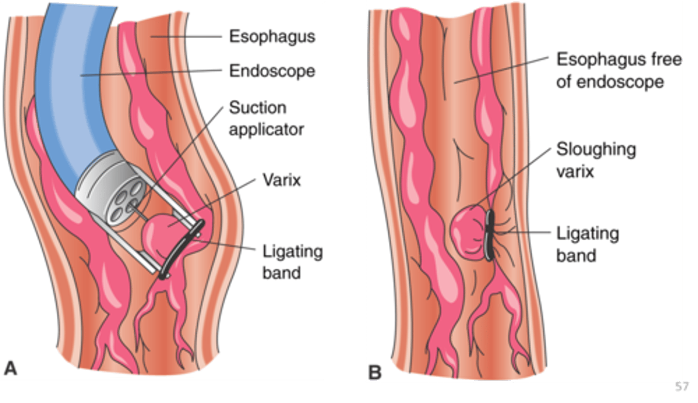 <p>- bands placed on base of varices → decrease blood flow to varices → stops the bleeding</p><p>- pt does not notice bands</p>
