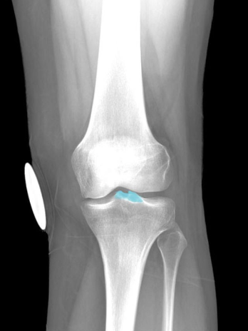 Function:
Provides attachment for lateral and
medial menisci, and anterior cruciate
ligament