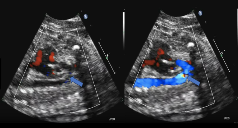 <p>a pt has hx of a child w/<strong>AO coarctation</strong>. which describes how to evaluate the fetus for this anomaly</p><p>.</p><p>a) assess the fetal pelvic for a single umbilical artery</p><p>b) obtain the LVOT + look for narrowing</p><p>c) place color doppler on the AO arch + proximal descending AO</p><p>d) place color doppler over the descending abd AO</p>