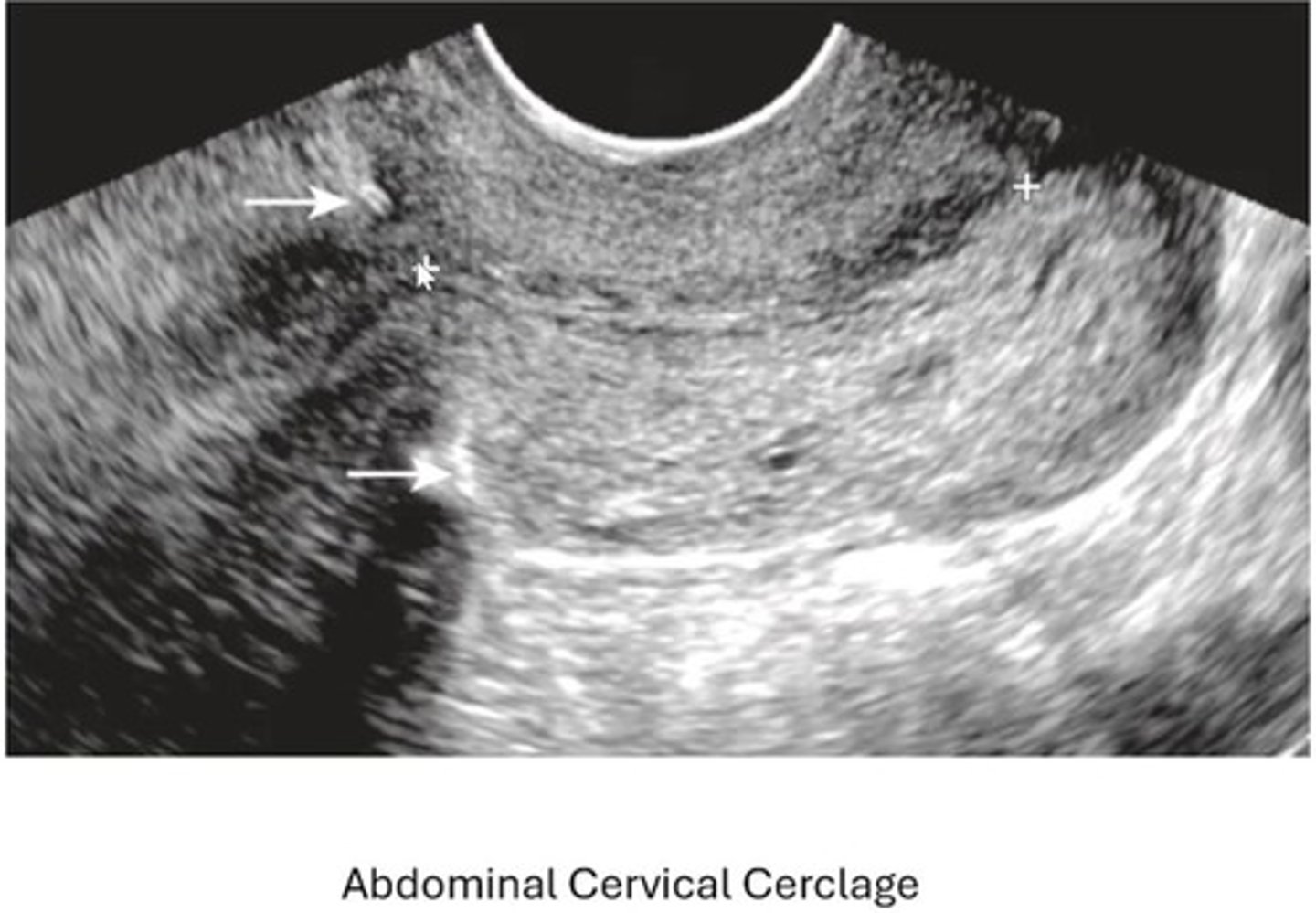 <p>Suture reinforcing cervical canal integrity inserted at 13-16 wk GA</p>