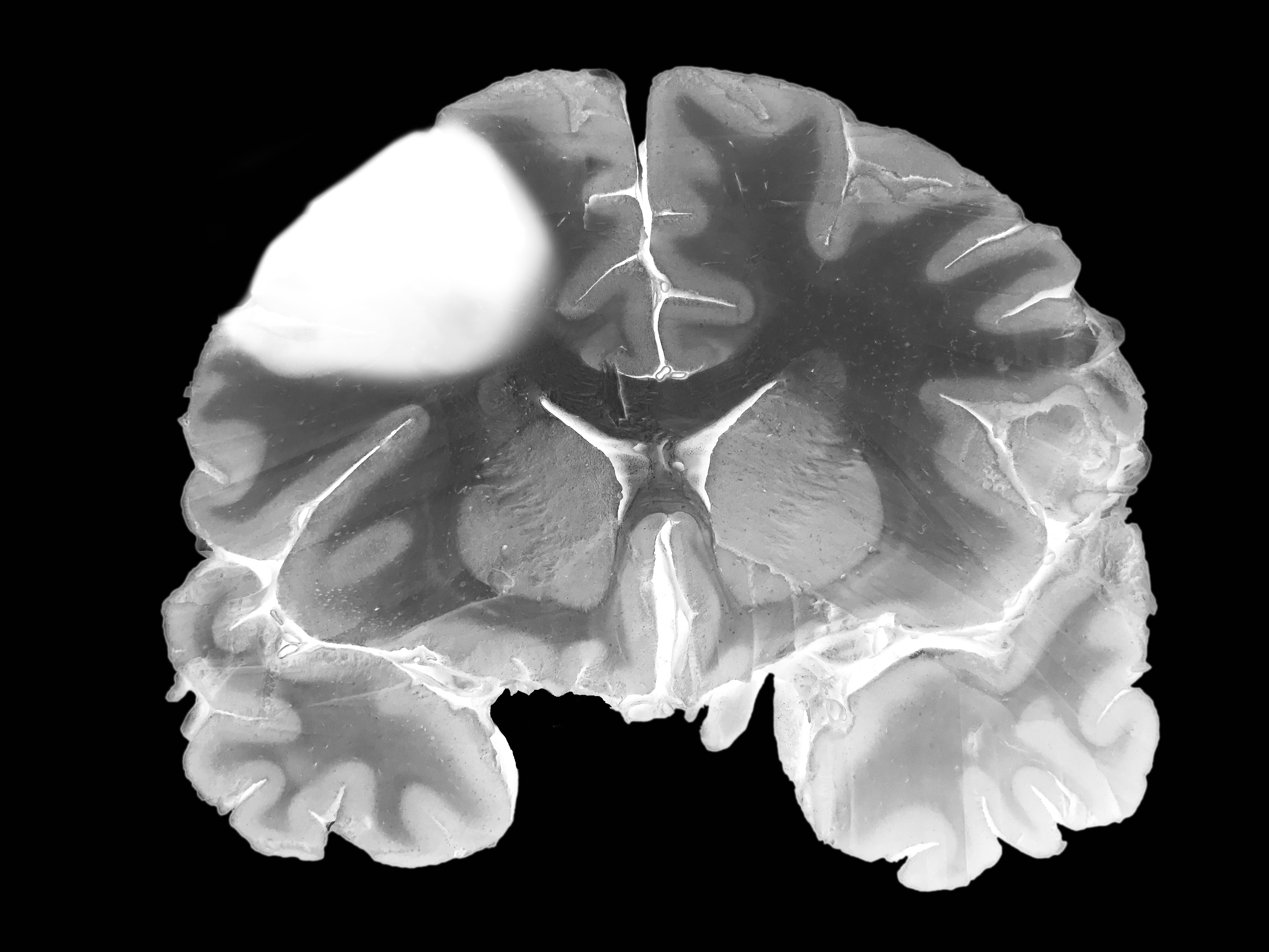 Traumatic Brain Injury