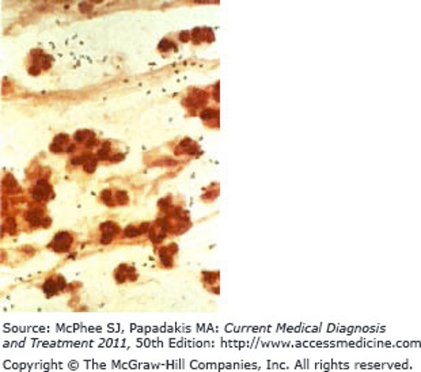 <p>The Correct Answer is: A</p><p>This patient is having an infection that is consistent with the bacterium Streptococcus pneumoniae. The best and most appropriate treatment for this pathogen is penicillins.</p>