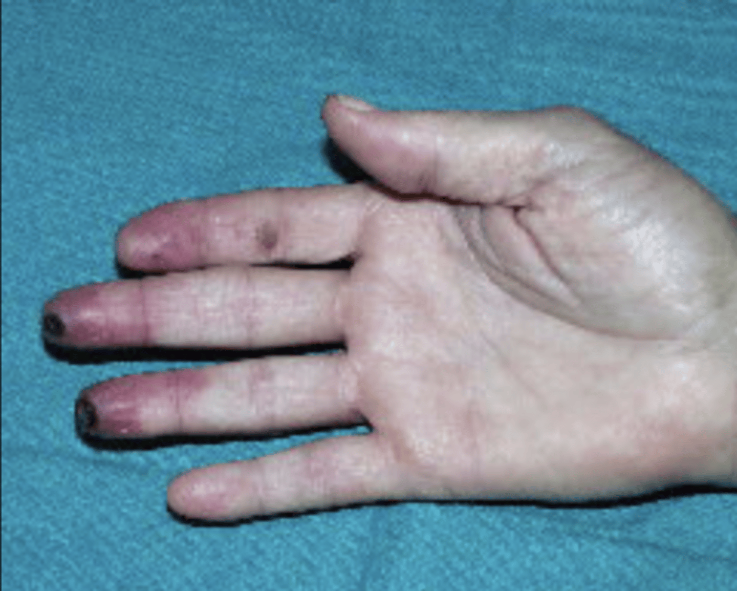 <p>Bilateral inflammatory disease of digital arteries in hands and feet</p><p>Always related to tobacco use</p><p>Fixed occlusive disease process</p><p>Ulcerations/gangrene - ¾ limb involvement common</p><p>Decreased distal pulses</p>