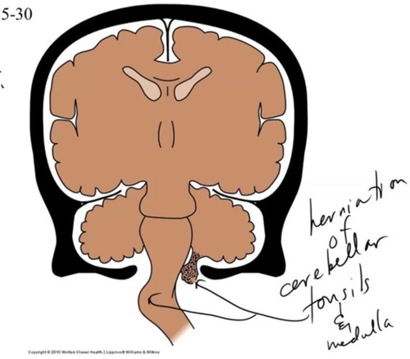 <p>Displacement of hindbrain downward through foramen</p><p>magnum to obstruct CSF flow</p><p>Associated with craniovertebral anomalies, such as spina bifada</p>