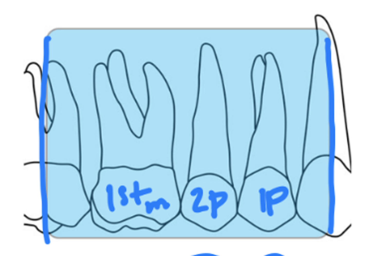 <p>size 2</p><p>distal of canine, 1st and 2nd premolars, 1st molar</p>