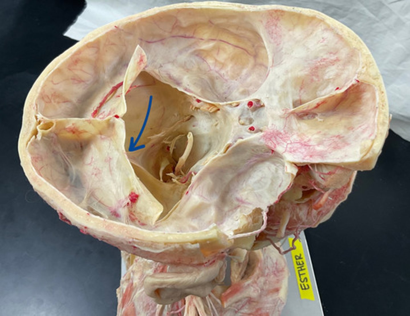 <p>closest view from pictures for ester, but it's under tentorium cerebelli, in line with falx cerebri</p>