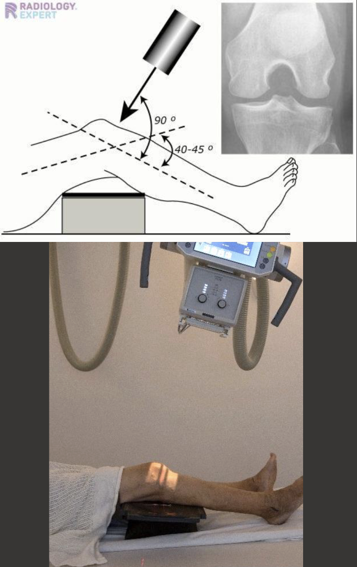 <p>Fine FS, 100cm</p><p>65kVp,5mAs</p><p>Tube angle 45 degrees cephalic (perpendicular to tib/fib)</p><p>CR: 2cm inferior to patellar apex</p>