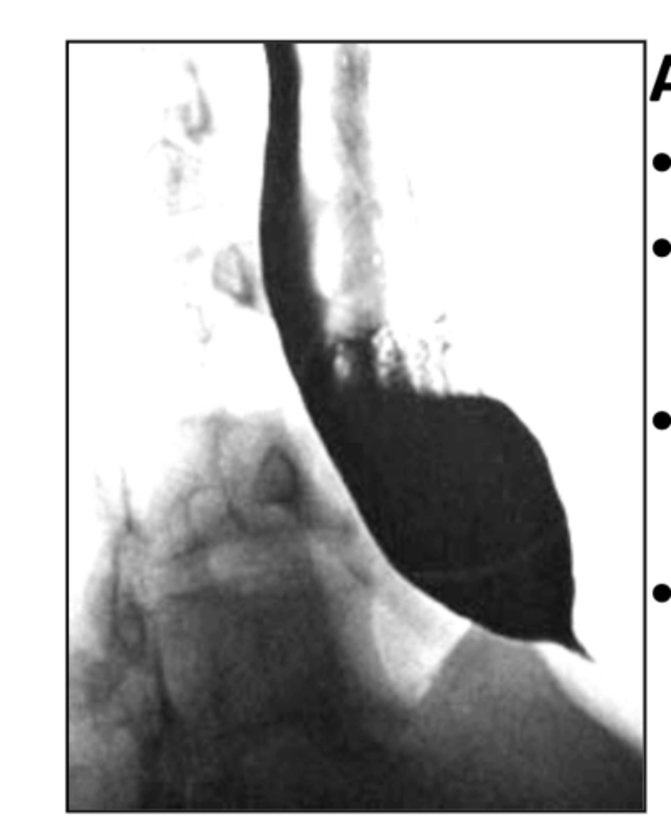 <p>esophageal motility disorder due to distal stricture caused by absent ganglion cells (birds beak appearance on barium swallow)</p><p>*causes dysphagia to solids &amp; liquids</p>