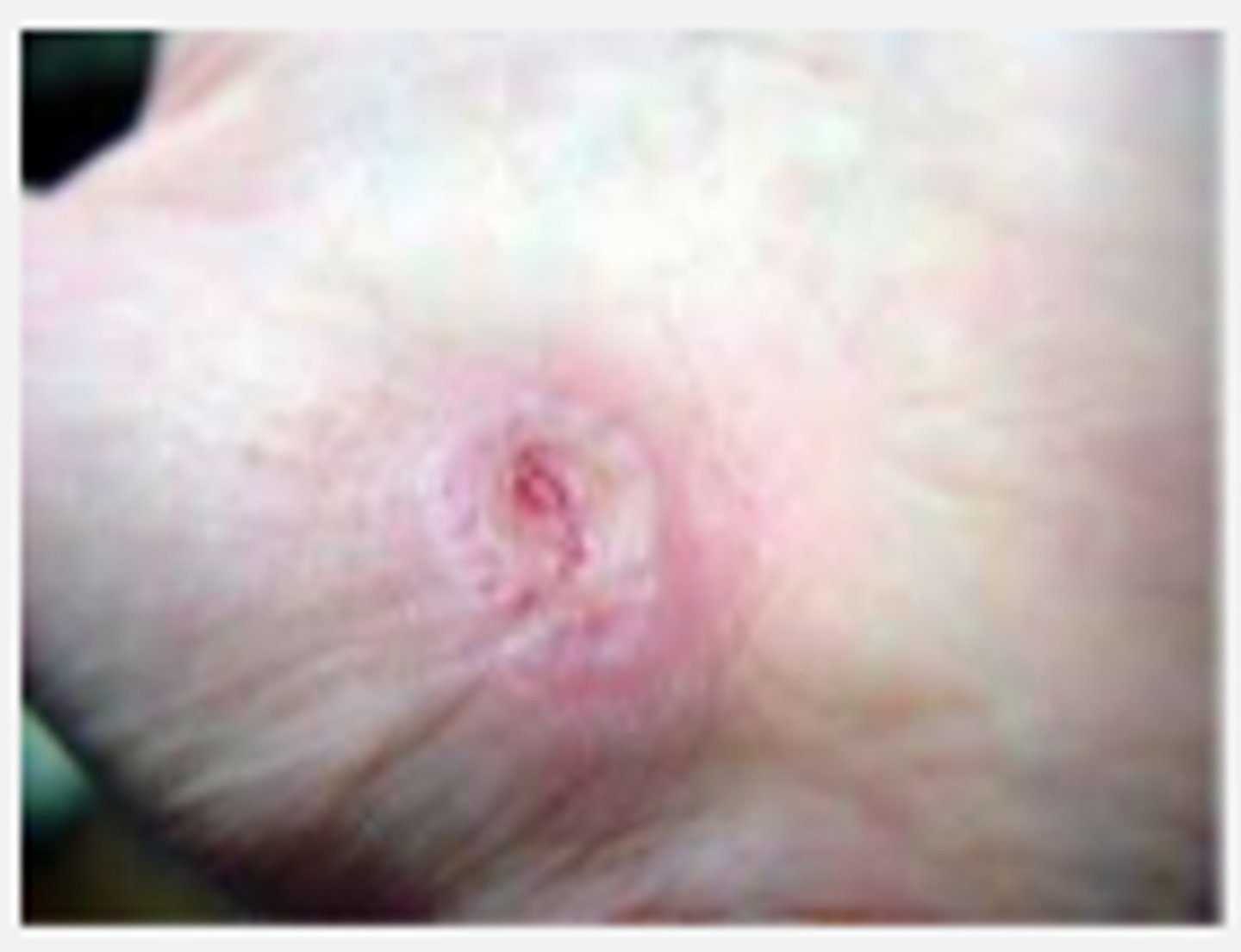 <p>WOUND BED ASSESSMENT</p><p>new growth of epidermis stratum basal</p><p>*faint purple</p><p>**speed of occurrence (0/5-1 mm/day)</p>