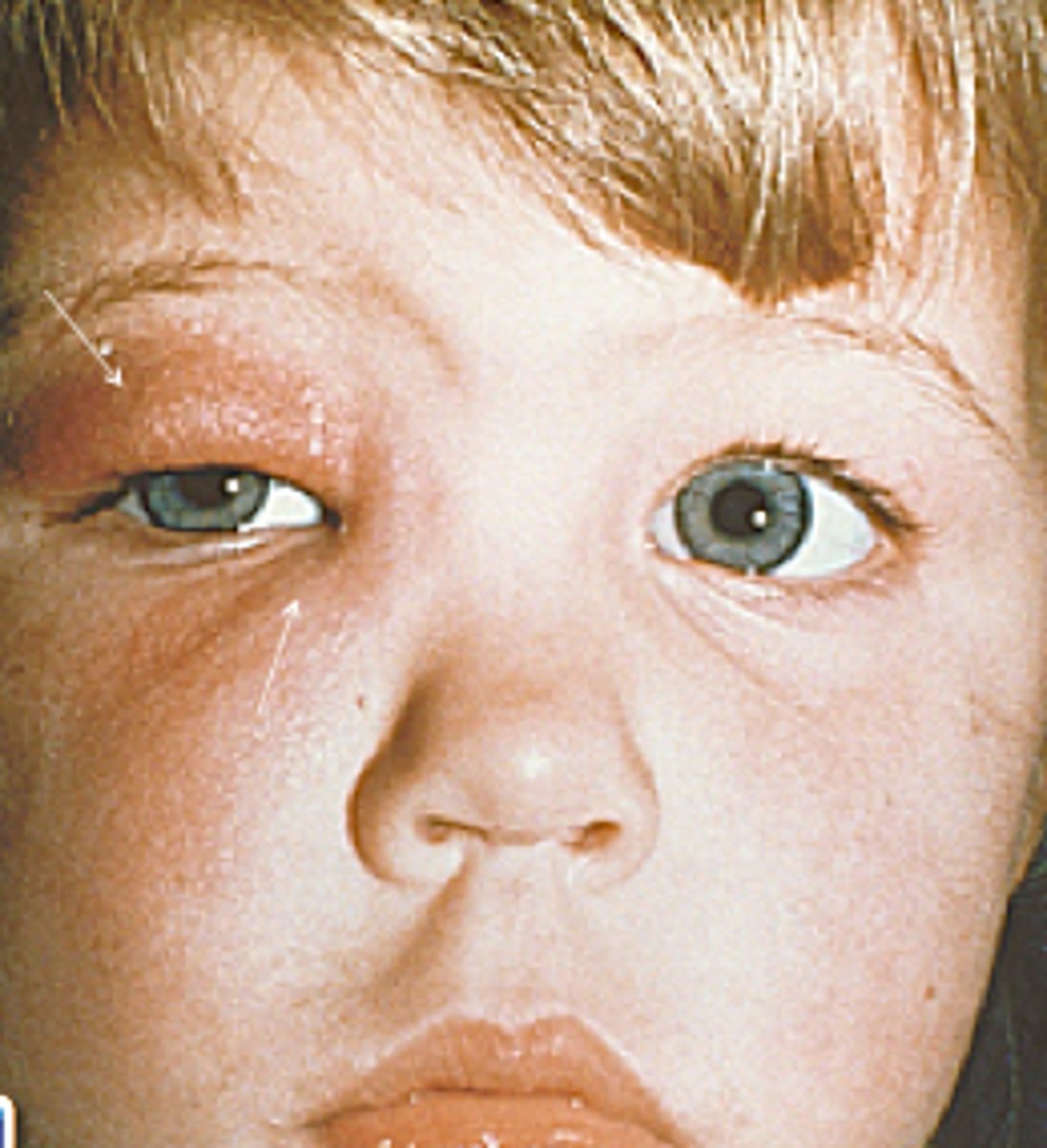 <p>Outpatient, empiric antibiotic therapy for 5-7 days with oral antibiotics such as Amoxicillin-clavulanic acid (Augmentin). Hospitalization with IV antibiotics may be necessary if the patient is under 1 year old or severely ill.</p>