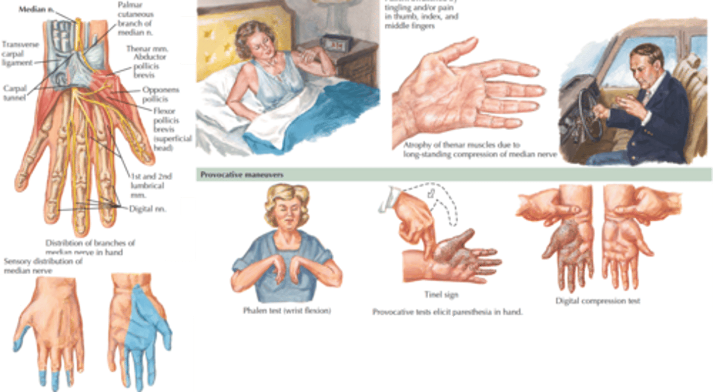 <p>Carpal tunnel</p>