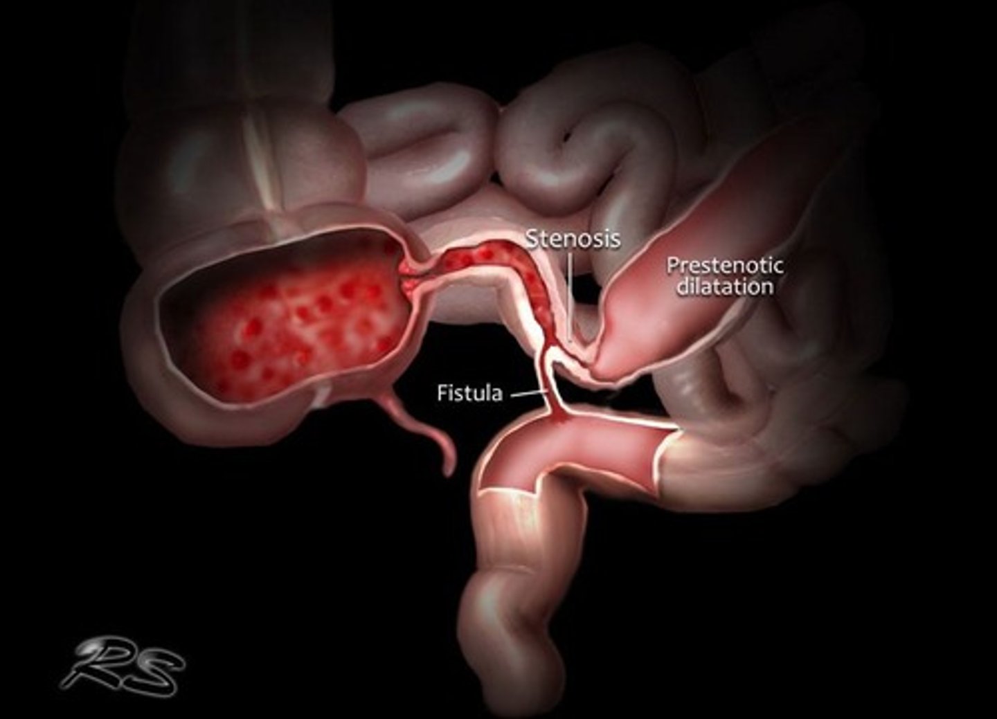 <p>Blockages, abscesses, and malabsorption.</p>