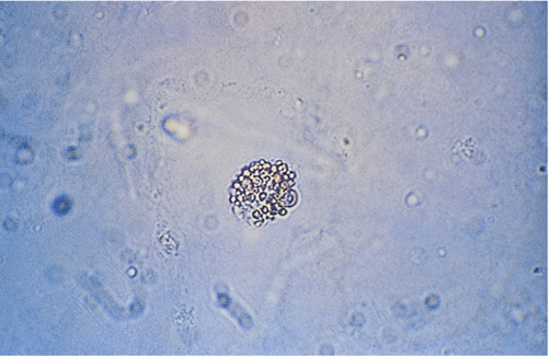 <p>what are oval fat bodies? what are oval fat bodies reported as? how would you know oval fat bodies are present?</p>