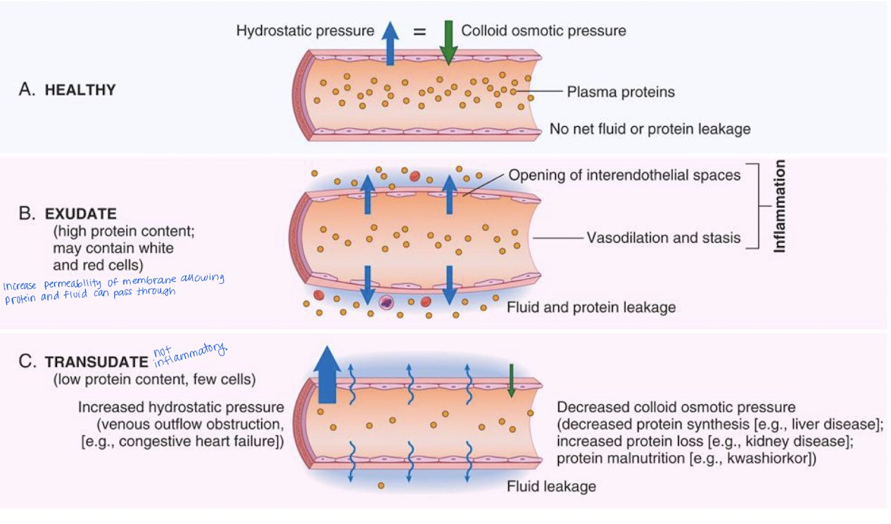 <p><strong>Exudate</strong> - protein rich fluid (opaque) and a <u>response to inflammation</u></p><p><strong>Transudate </strong>- intersitiual fluid accumulation caused by increased hydrostatic pressure</p><ul><li><p>low protein concentration</p></li><li><p><u>non-inflammatory response</u></p></li></ul><p></p>