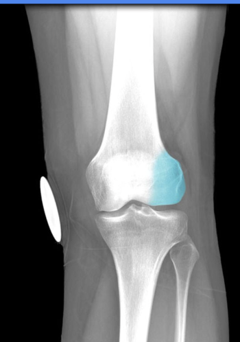 Description:
Lateral enlargement of distal end
Smooth surface articulates with tibia
and patella