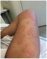 <p>What is serum sickness</p>