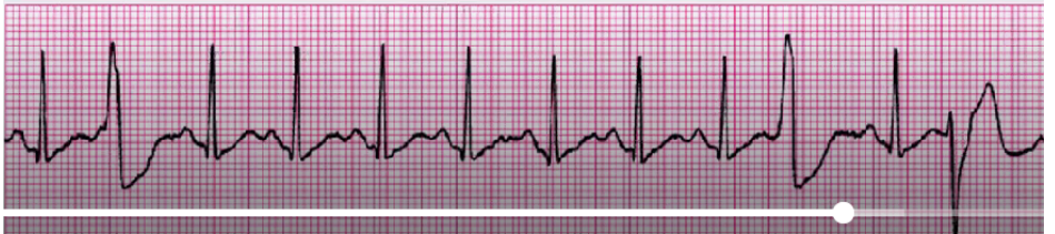 <p>assess BP, change in LOC, breathing, chest pain</p><p>Asx - monitor, treat underlying cause (hypoxia, electrolytes, HF, MI, post CABG, reperfusions, catheters in RV, anxiety, caffeine/stimulants)</p><p>DO NOT COUNT PVCs IN HR COUNT</p>
