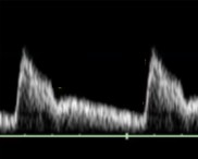 <p>The patient dopplered on is at 32 weeks’ gestation. This is the uterine artery.</p><ol><li><p>Is this waveform normal for how far they are?</p></li><li><p>If not, what could this indicate? </p></li></ol><p></p>