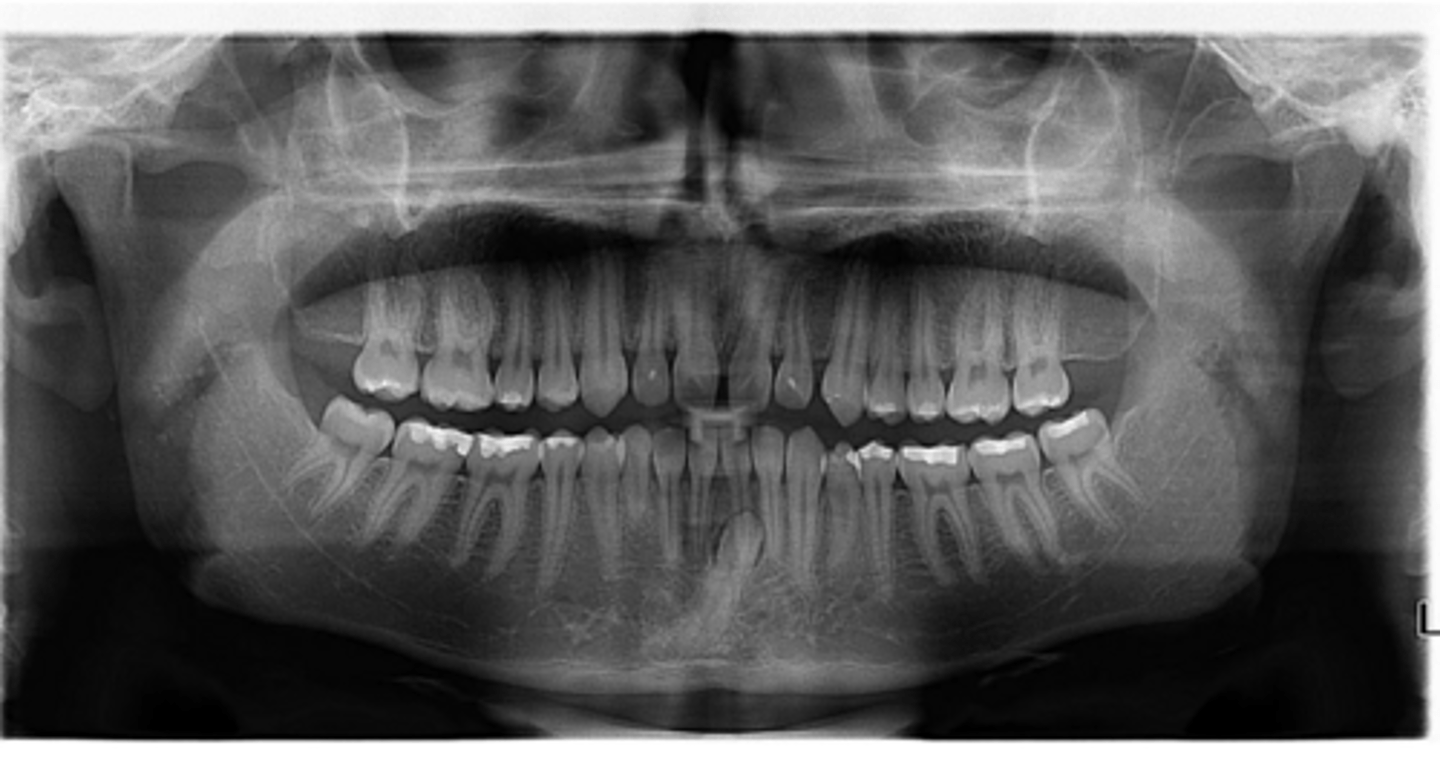 <p>Is there any ectopic eruption?</p>