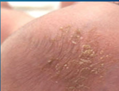 <p><strong>Seborrheic Dermatitis: Background and Infant Presentation</strong></p><p>-Common, chronic inflammatory disease accompanied by overproduction of _____</p><p>-Pathogenesis </p><ul><li><p>Unknown but thought to be an abnormal inflammatory response to _________ species in sebum rich areas </p></li><li><p>Common areas affected are _____, _________, eyelids, nasolabial folds, external auditory canal, and posterior auricular folds </p></li></ul><p>-Infants (______ ___)</p><ul><li><p>Begins during ______ month of life </p></li><li><p>Resolves around _ year </p></li><li><p>Most often on vertex of scalp </p></li><li><p>______, greasy/waxy, yellow-white scaling and __________ of scalp</p></li><li><p>Asymptomatic </p></li></ul><p></p>