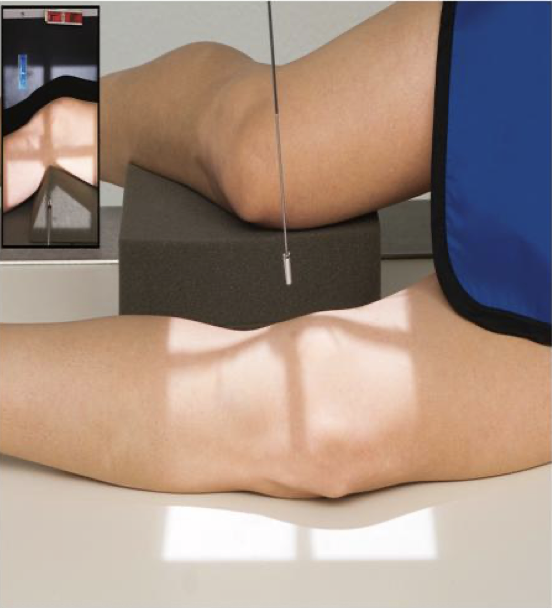 <p>Patient Position   </p><p class="p1"><span style="line-height: normal;"><span>• </span></span>Lying on affected side</p><p class="p1"><span style="line-height: normal;"><span>• </span></span>Unaffected leg either behind or in front of affected leg</p><p class="p1"><span style="line-height: normal;"><span>• </span></span>(can be standing)</p><p class="p1"></p><p class="p1">Part Position</p><p class="p1"><span style="line-height: normal;"><span>• </span></span>Affected knee is flexed 20-30°</p><ul><li><p class="p1"><span style="line-height: normal;"><span> </span></span>Some texts suggest only 10- 15 °</p></li></ul><p class="p1"><span style="line-height: normal;"><span>• </span></span>Use caution if flexing injured knee; may leave knee extended or partially flexed</p><p class="p1"><span style="line-height: normal;"><span>• </span></span>Knee in a true lateral</p><ul><li><p class="p1"><span style="line-height: normal;"><span> </span></span>Femoral epicondyles are superimposed</p></li><li><p class="p1"><span style="line-height: normal;"><span> </span></span>Patellar surface is perpendicular to IR</p></li></ul><p class="p1"></p><p class="p1">CR</p><p class="p1"><span style="line-height: normal;"><span>• </span></span>CR is angled 5-7° cephalad; centered 2.5 cm inferior to medial epicondyle of femur</p><ul><li><p class="p1"><span style="line-height: normal;"><span> </span></span>≤ 5° for taller, thinner patients</p></li><li><p class="p1"><span style="line-height: normal;"><span> </span></span>≥ 7 ° for shorter patients with wider pelvis</p></li></ul><p class="p1"><span style="line-height: normal;"><span>• </span></span>Tip: rotate collimator so CR is directed across the femoral condyles</p><p class="p1"></p><p class="p1">Collimation</p><ul><li><p class="p1">Include distal femur/proximal tib/fib</p></li></ul><p class="p1"></p><p class="p1">NOTE: May use “boomerang” filter for better soft tissue demonstration</p>