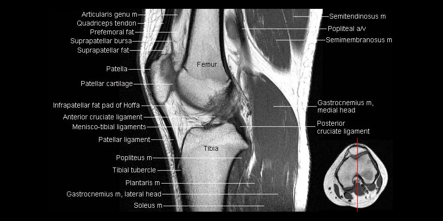 <p>prepatellar bursitis</p><p>A round high signal intensity structure, consistent with a fluid given the T2 weighted MRI, is located superficial to the patella ligament</p><p>(inflammation within the prepatellar bursa)</p><p>(prepattar = most common)</p><img src="https://knowt-user-attachments.s3.amazonaws.com/2bd3eb26-4d0c-4720-888f-4d73b9946190.png" data-width="100%" data-align="center" alt=""><p></p>