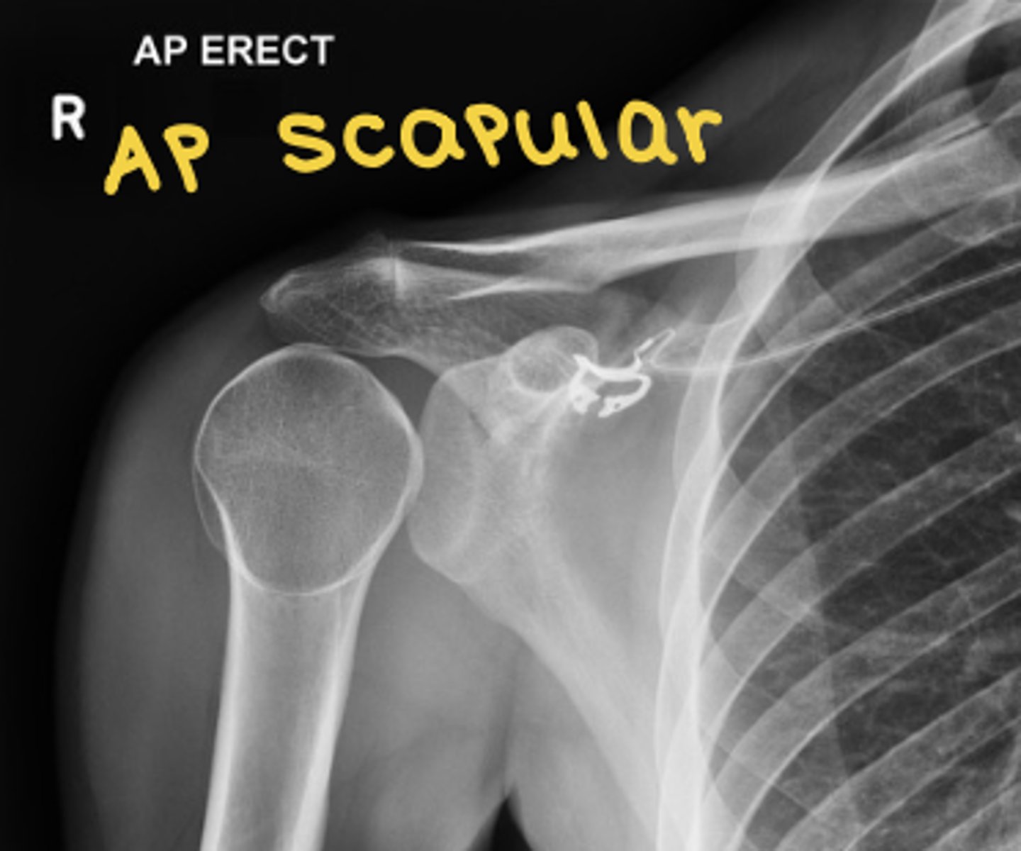 <p>clearest view of scapula</p>