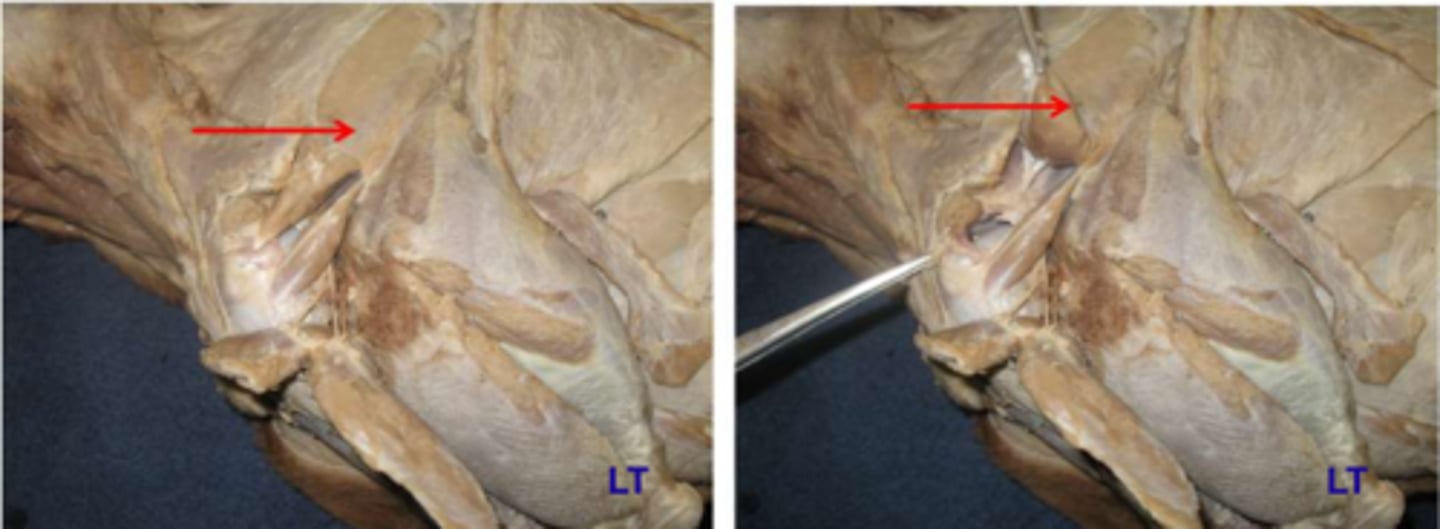 <p>Origen: fosa infraespinosa</p><p>Inserción: Tubérculo mayor húmero </p><p>Función: Flexor articulación hombro, ligamento tensor contráctil (suple la función de lig. colateral lt) Inervación: n. supraescapular </p><p>Región: cubierto por el deltoides. Debajo de él se localiza el n. supraescapular.</p>