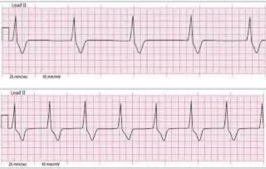 <p>What is the rhythm in the following two ECG strips and what characteristic differentiates the 2 rhythms?</p>