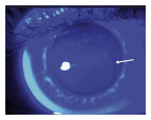 <p><span>Iron Oxide Hemosiderin <strong>deposits in the corneal epithelium</strong> seen at the base of the cone</span></p>
