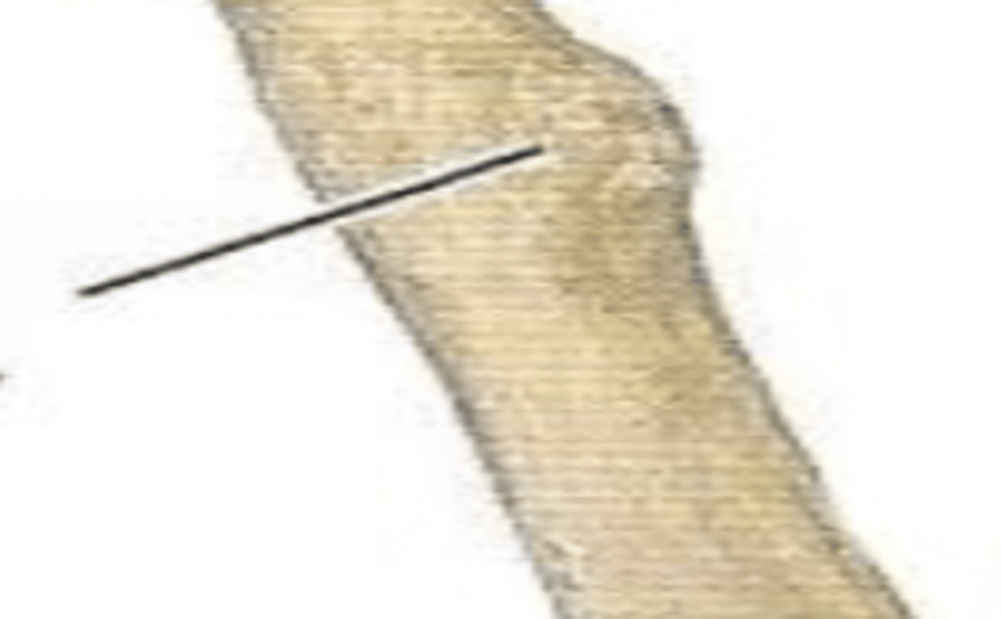 <p>radial tuberosity</p>