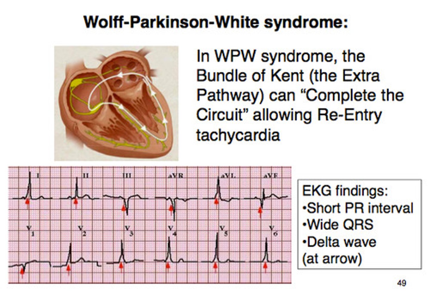 <p>- short PR interval</p><p>- early slurred delta wave in QRS complex</p>