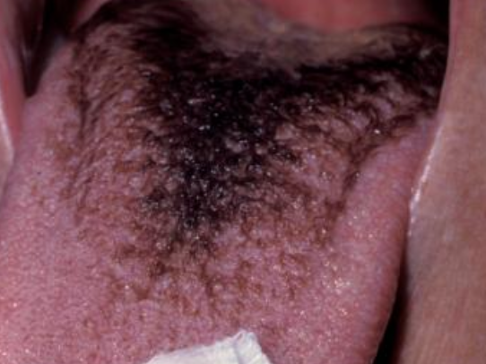 <p>What is the cause of hairy tongue?</p>