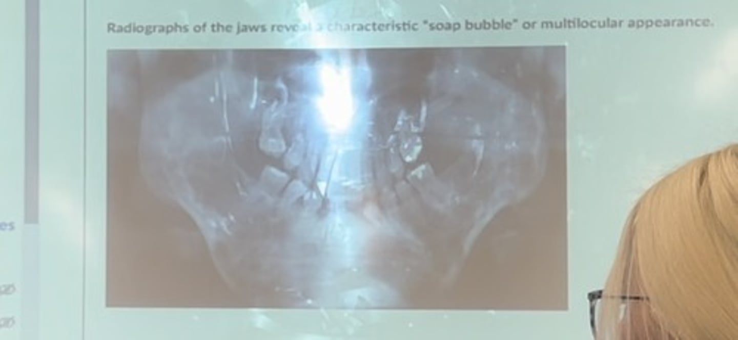 <p>Radiographs of the jaws reveal a charcteristic "soap bubble" or multiocular appearance</p>