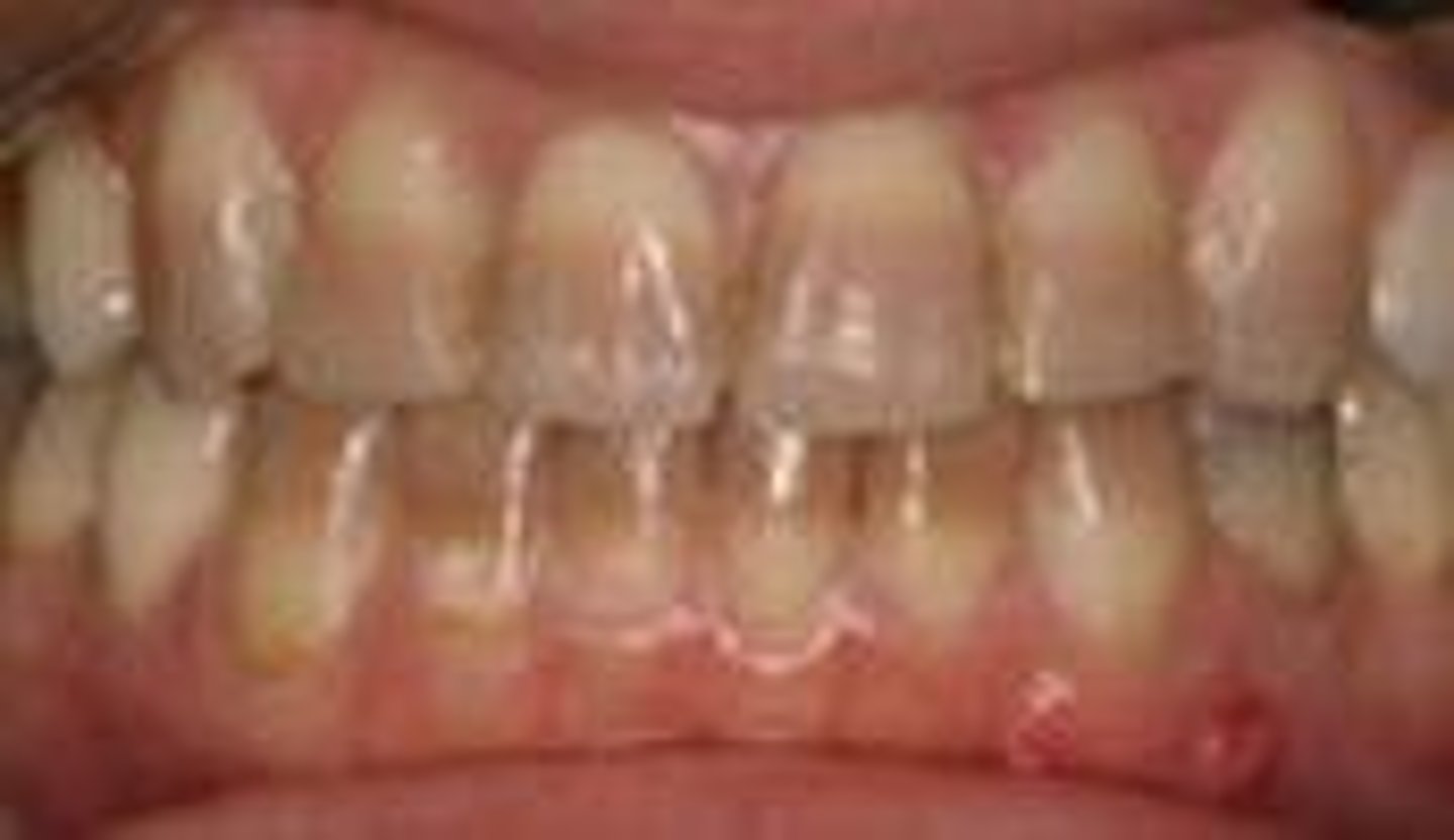 <p>A systemic antibiotic that binds irreversibly to dentin and stains both sets of dentition.</p>