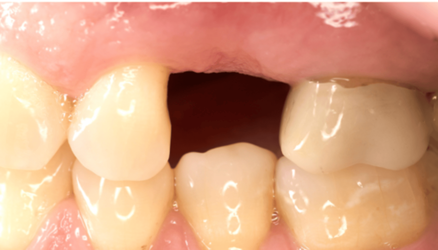 <p>When you evaluate restorative space #4, what aspects you need to check ? (select all apply)</p><p>A. Adjacent tooth proximal contact morphology</p><p>B. Mesio-distal dimension</p><p>C. Soft tissue thickness (Vertical)</p><p>D. Bone density</p><p>E. Vertical space (occlusal-cervical direction)</p>