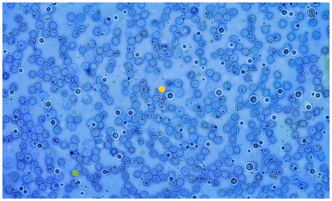 <p><strong><em>Babesia canis</em></strong></p><p><span data-name="yellow_circle" data-type="emoji">🟡</span> - Tetrada merozoitów (krzyż maltański)</p><p><span data-name="green_circle" data-type="emoji">🟢</span>- Stadium pierścienia</p><p></p><p></p><p><strong>Parazytoza: </strong><em>Babeszjoza</em></p>