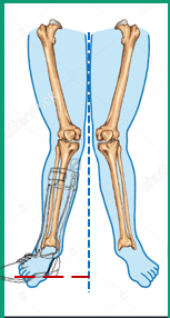 <p>Excessive pressure on the medial surface of the foot </p>