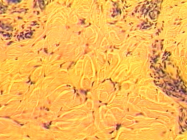 <p>Dense Irregular CT</p>