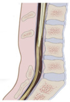 <p>What type of spina bifida is this? </p>