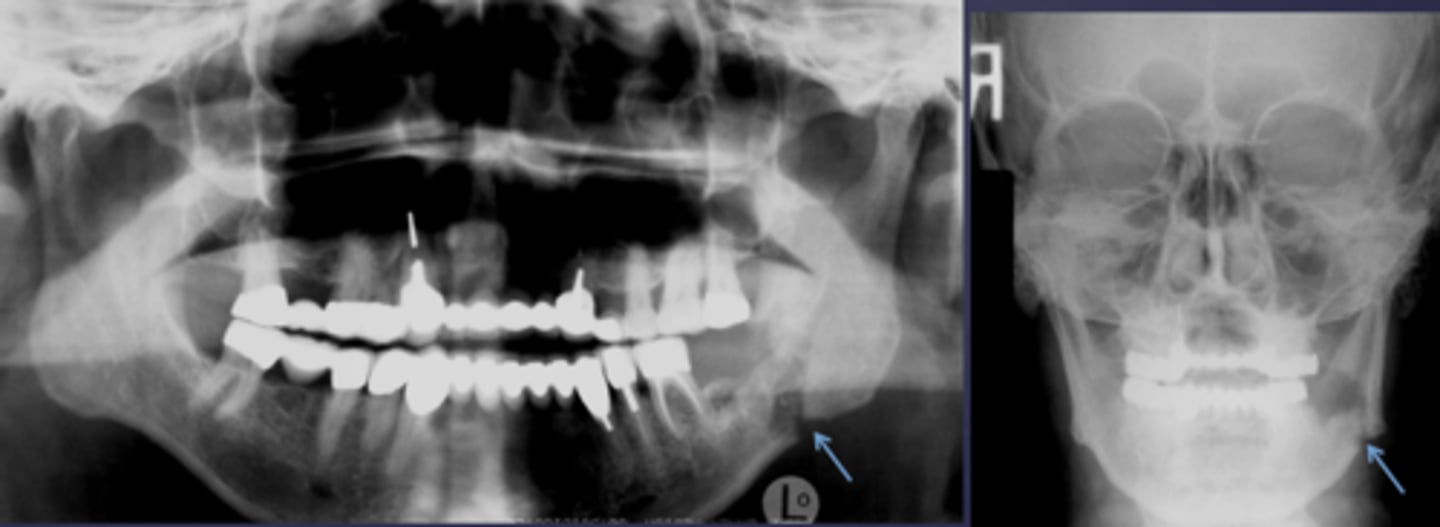 <p>Osteomyelitis caused what to occur?</p>