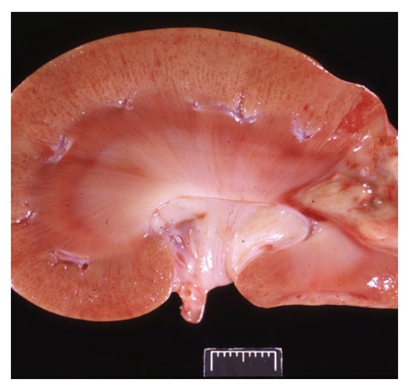 <p>Ulcerative endocarditis - cause</p>