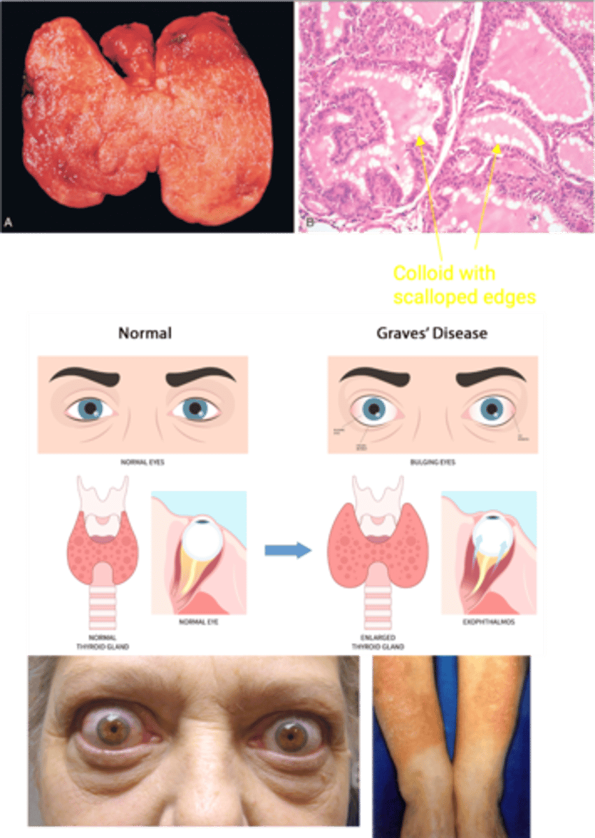 <p>Define Condition:</p><p>MCC of Hyperthyroidism</p><p>-Path: Autoimmune response against multiple thyroid antigens (most important = TSH receptor) --&gt; TSH-receptor Antibody (TRAb), aka Thyroid-stimulating Immunoglobulin (TSI)</p><p>&gt; IgG Autoantibody that mimics TSH --&gt; Binds TSH receptor --&gt; Follicular cells release TH --&gt; More T3/T4, but Less TSH</p><p>-Sx/PE:</p><p>&gt; Diffuse thyroid enlargement</p><p>&gt; Bulging Eyes (infiltrative ophthalmopathy w/ exophthalmos)</p><p>&gt;&gt; CD4 T cells secreting cytokines and orbital fibroblasts have TSH receptors -&gt; TSH receptors stimulated by TRAb -&gt; fibroblast proliferation and secretion of hydrophilic glycosaminoglycans -&gt; draws in water -&gt; swelling</p><p>&gt; Pretibial Myxedema (aka Infiltrative Dermopathy)</p><p>&gt;&gt; Deposition of glycosaminoglycans (HA) in dermis and subcutis</p><p>&gt;&gt; Early lesions are bilateral, firm, non-pitting, asymmetrical plaques or nodules</p><p>&gt;&gt; Can coalesce to form scaly, thickened and hardened skin areas</p><p>&gt;&gt; Overlying skin may be discolored</p><p>-Dx:</p><p>&gt; Gross = Diffusely enlarged thyroid</p><p>&gt; Micro =</p><p>&gt;&gt; Tall, crowded epithelial cells --&gt; papillae</p><p>&gt;&gt; Pale, scalloped colloid</p><p>&gt;&gt; Lymphocytes (mostly T cells), plasma cells</p>
